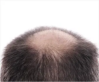 costo-depende-de-cada-paciente-el-nivel-de-calvicie-y-la-cantidad-de-foliculos-capilar-hair-center-tijuana