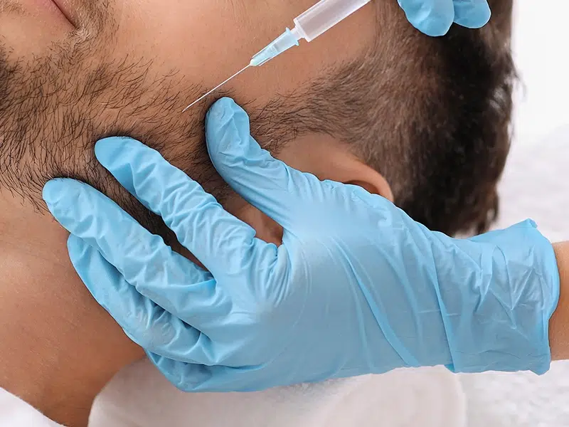 el-trasplante-de-barba-es-posible-con-esta-tecnica-capilar-hair-center-tijuana