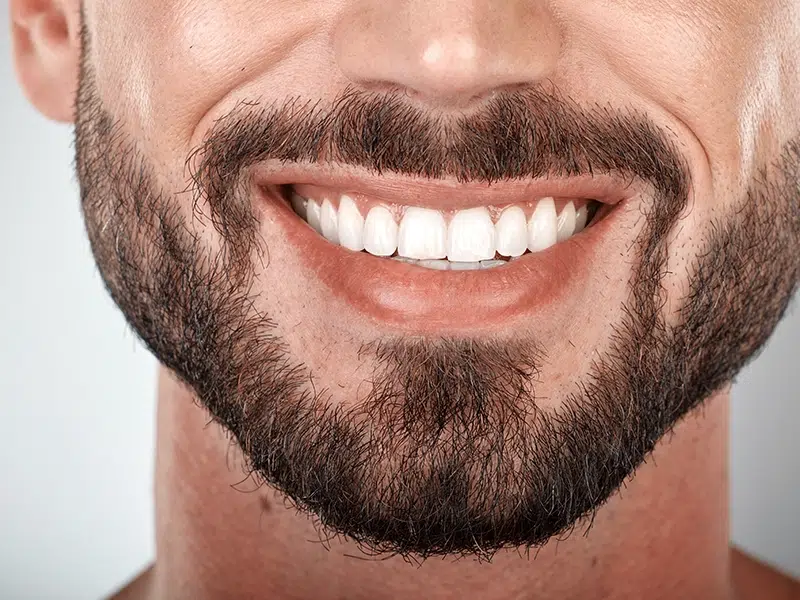 implantes-de-barba-la-solucion-para-lograr-barba-perfecta-capilar-hair-center-tijuana
